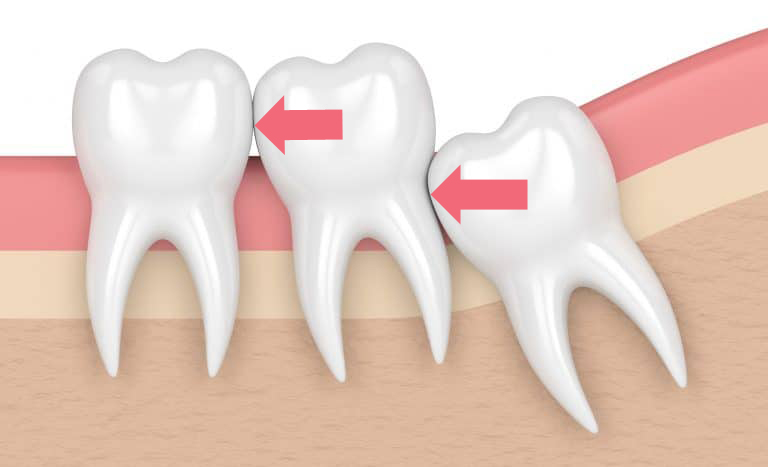 Impacted Wisdom Teeth